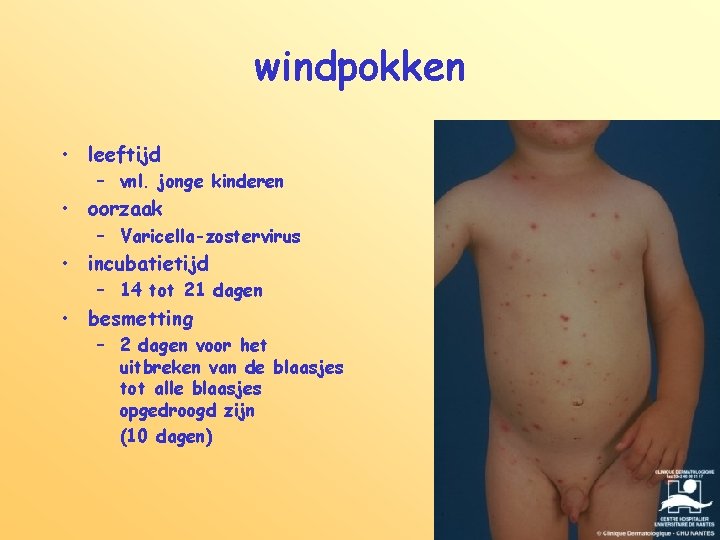 windpokken • leeftijd – vnl. jonge kinderen • oorzaak – Varicella-zostervirus • incubatietijd –