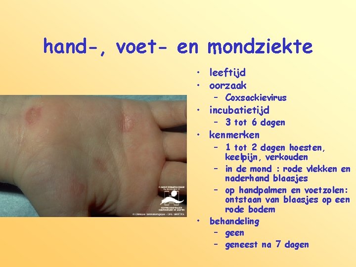 hand-, voet- en mondziekte • leeftijd • oorzaak – Coxsackievirus • incubatietijd – 3