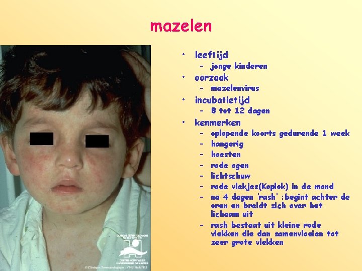 mazelen • leeftijd • oorzaak • incubatietijd • kenmerken – jonge kinderen – mazelenvirus