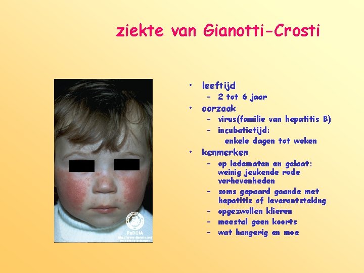 ziekte van Gianotti-Crosti • leeftijd • oorzaak • kenmerken – 2 tot 6 jaar