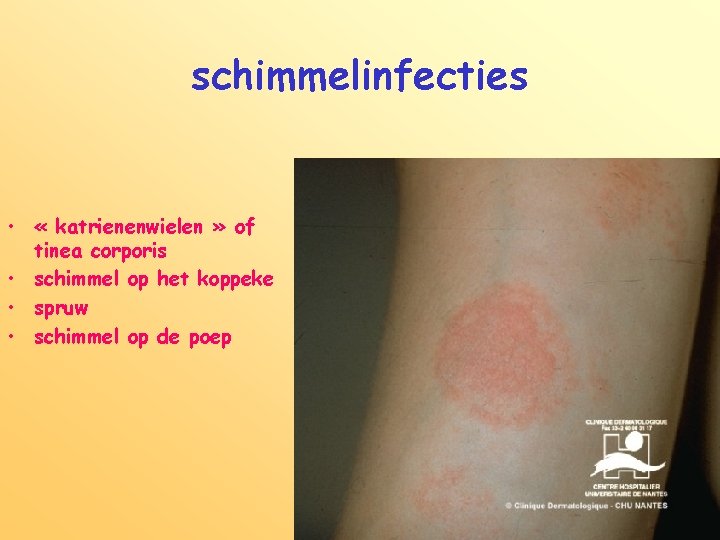 schimmelinfecties • « katrienenwielen » of tinea corporis • schimmel op het koppeke •