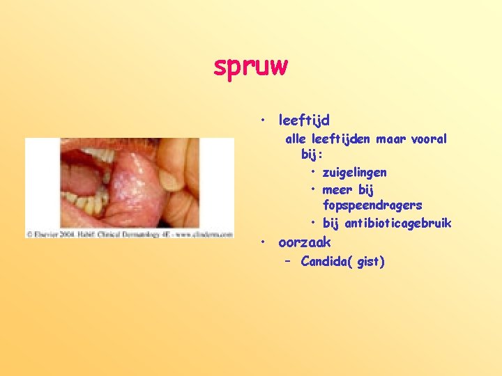 spruw • leeftijd alle leeftijden maar vooral bij: • zuigelingen • meer bij fopspeendragers