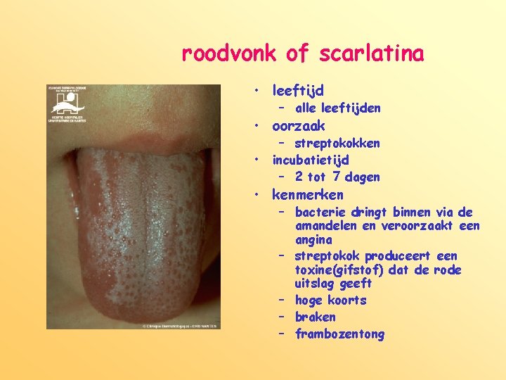 roodvonk of scarlatina • leeftijd – alle leeftijden • oorzaak • – streptokokken incubatietijd