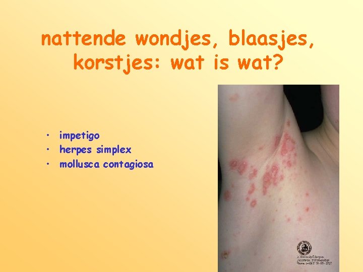 nattende wondjes, blaasjes, korstjes: wat is wat? • impetigo • herpes simplex • mollusca