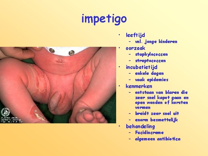 impetigo • leeftijd • oorzaak • incubatietijd • kenmerken • behandeling – vnl. jonge