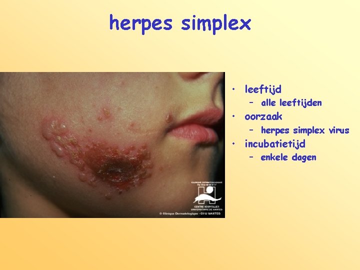 herpes simplex • leeftijd – alle leeftijden • oorzaak – herpes simplex virus •