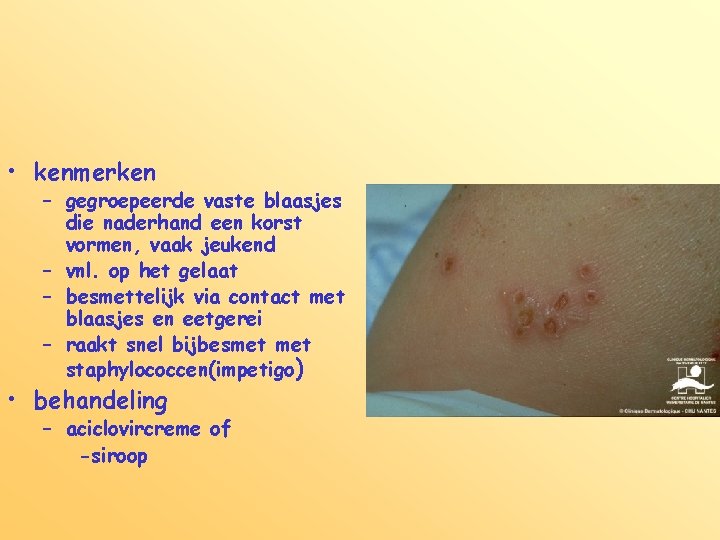  • kenmerken – gegroepeerde vaste blaasjes die naderhand een korst vormen, vaak jeukend