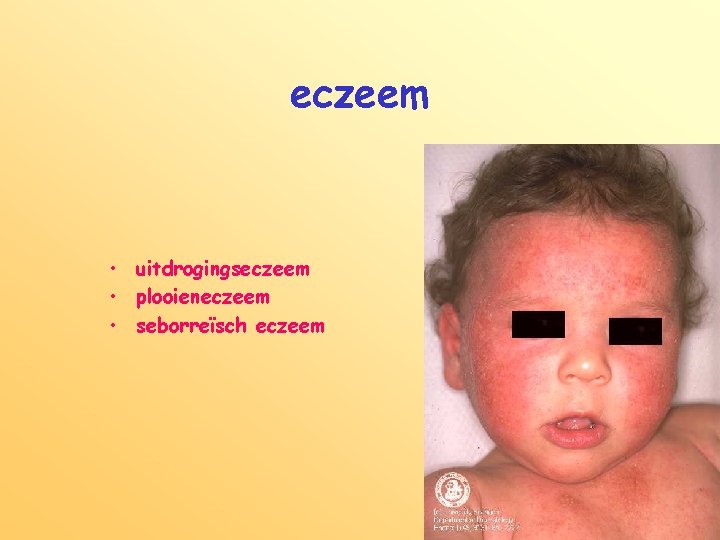 eczeem • uitdrogingseczeem • plooieneczeem • seborreïsch eczeem 