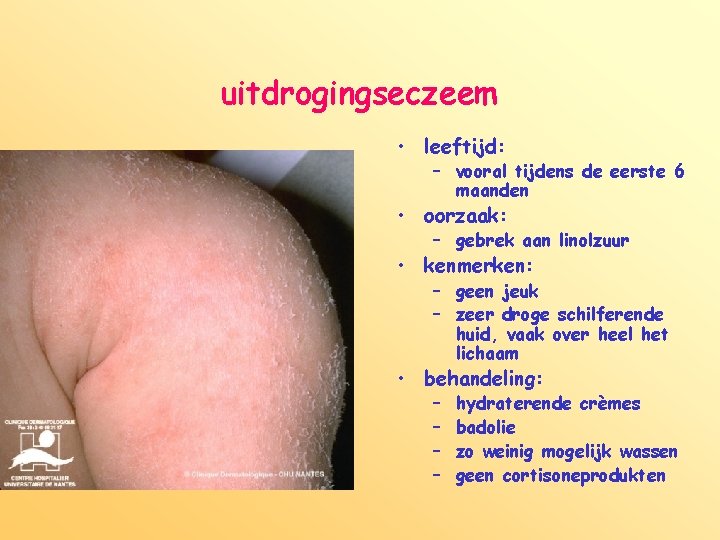 uitdrogingseczeem • leeftijd: – vooral tijdens de eerste 6 maanden • oorzaak: – gebrek