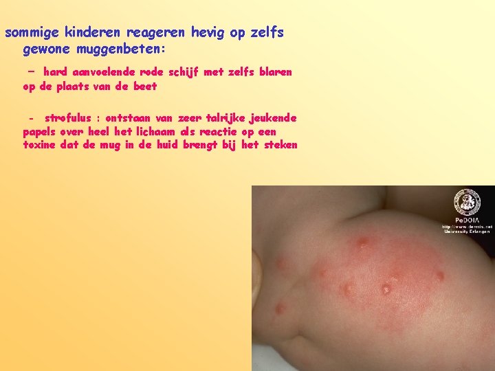 sommige kinderen reageren hevig op zelfs gewone muggenbeten: - hard aanvoelende rode schijf met