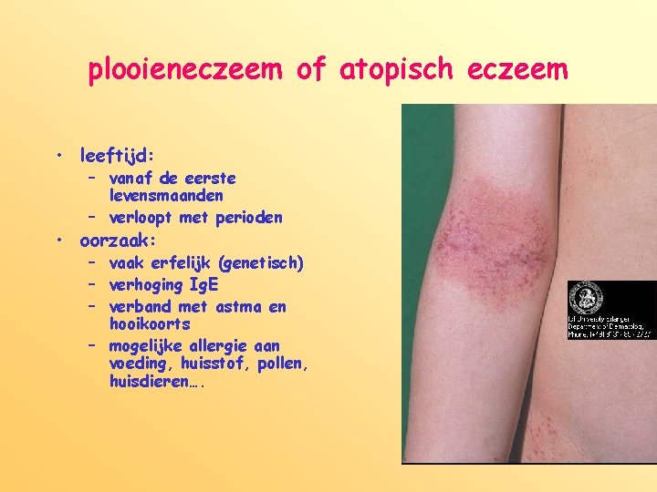 plooieneczeem of atopisch eczeem • leeftijd: – vanaf de eerste levensmaanden – verloopt met