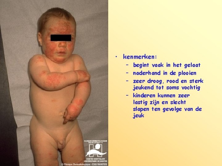  • kenmerken: – begint vaak in het gelaat – naderhand in de plooien