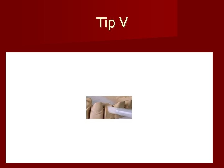 Tip V 