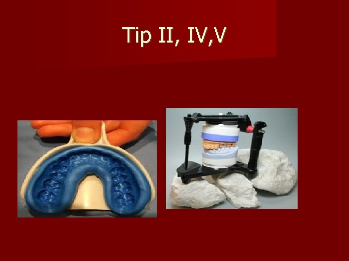 Tip II, IV, V 