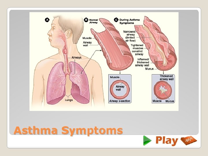 Asthma Symptoms 