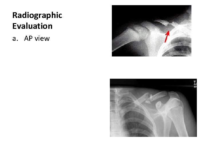 Radiographic Evaluation a. AP view Radiographic Evaluation a. AP view