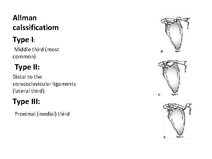 Allman calssificatiom Type I: Middle third (most common) Type II: Distal to the coracoclavicular Allman calssificatiom Type I: Middle third (most common) Type II: Distal to the coracoclavicular