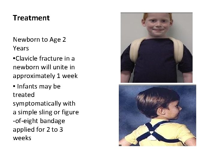Treatment Newborn to Age 2 Years • Clavicle fracture in a newborn will unite Treatment Newborn to Age 2 Years • Clavicle fracture in a newborn will unite