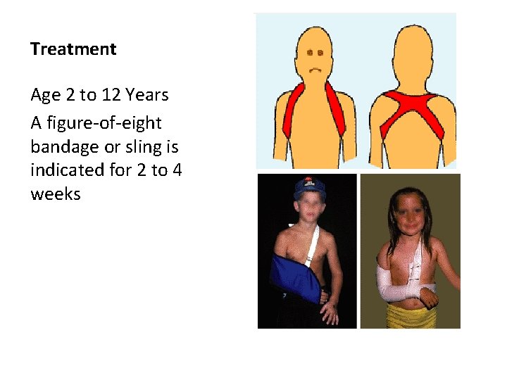Treatment Age 2 to 12 Years A figure-of-eight bandage or sling is indicated for Treatment Age 2 to 12 Years A figure-of-eight bandage or sling is indicated for