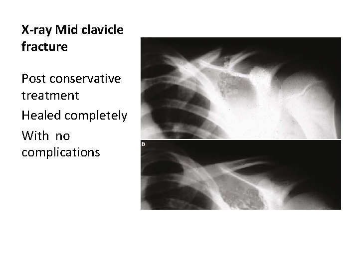 X-ray Mid clavicle fracture Post conservative treatment Healed completely With no complications X-ray Mid clavicle fracture Post conservative treatment Healed completely With no complications