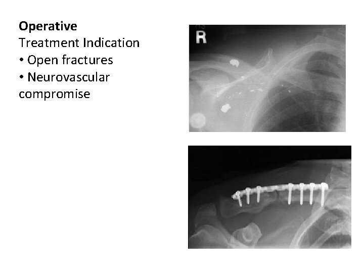 Operative Treatment Indication • Open fractures • Neurovascular compromise Operative Treatment Indication • Open fractures • Neurovascular compromise