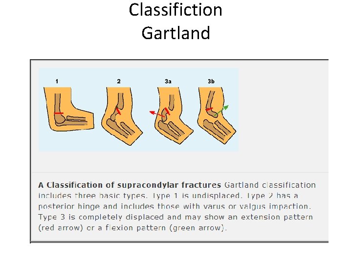 Classifiction Gartland Classifiction Gartland
