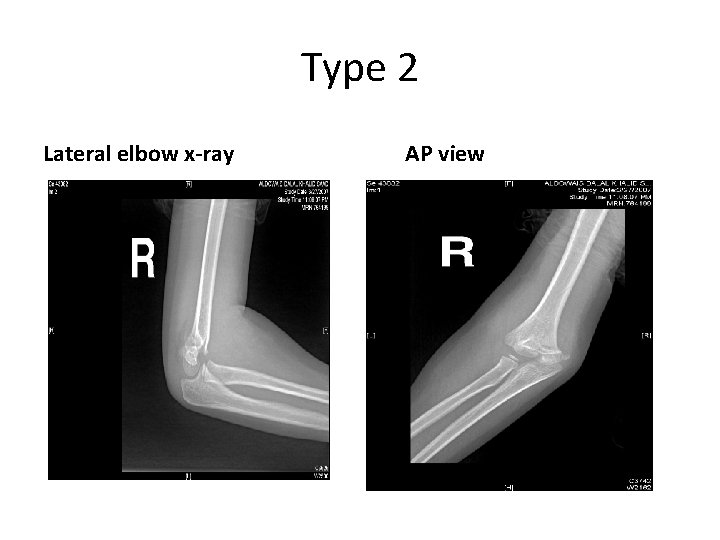 Type 2 Lateral elbow x-ray AP view Type 2 Lateral elbow x-ray AP view
