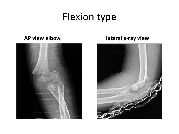 Flexion type AP view elbow lateral x-ray view Flexion type AP view elbow lateral x-ray view