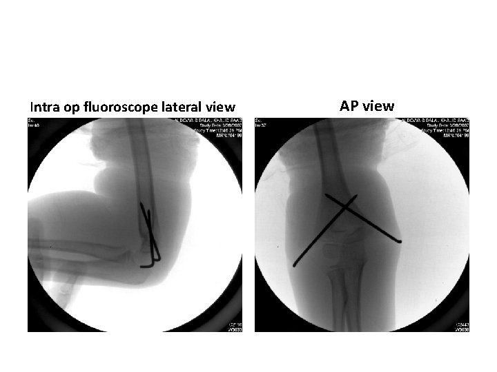 Intra op fluoroscope lateral view AP view Intra op fluoroscope lateral view AP view