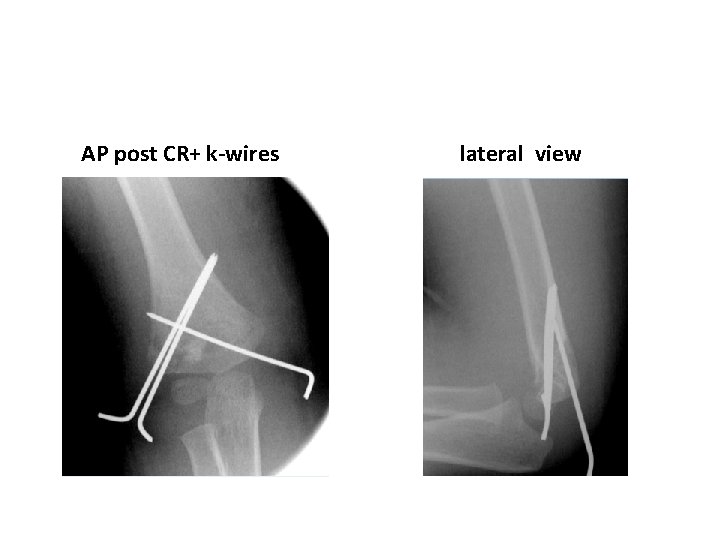 AP post CR+ k-wires lateral view AP post CR+ k-wires lateral view