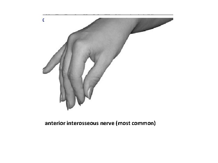 anterior interosseous nerve (most common) anterior interosseous nerve (most common)