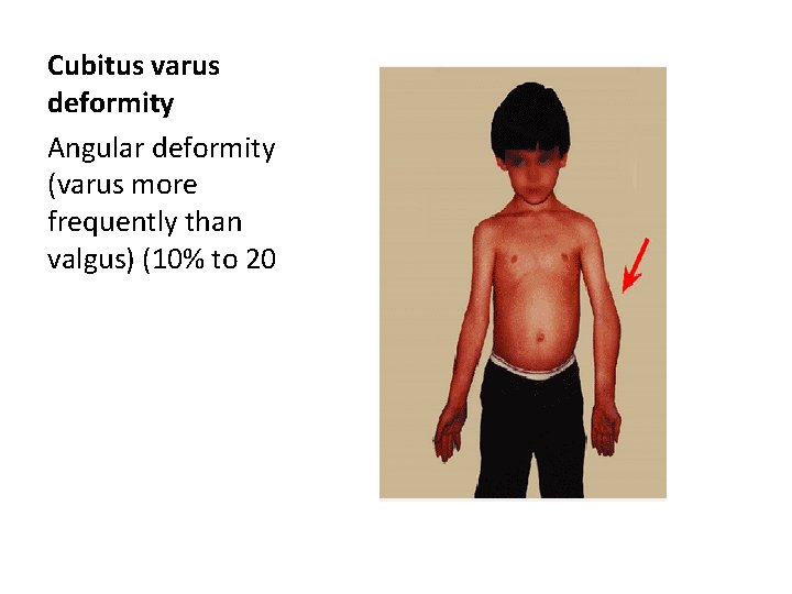 Cubitus varus deformity Angular deformity (varus more frequently than valgus) (10% to 20 Cubitus varus deformity Angular deformity (varus more frequently than valgus) (10% to 20