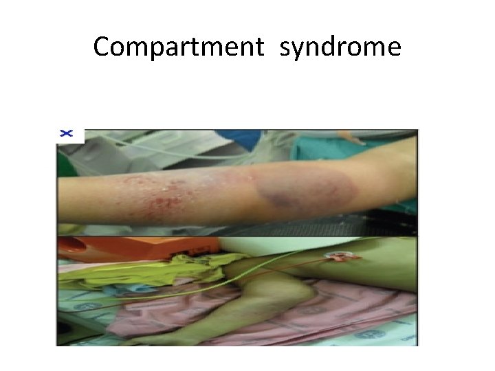 Compartment syndrome Compartment syndrome