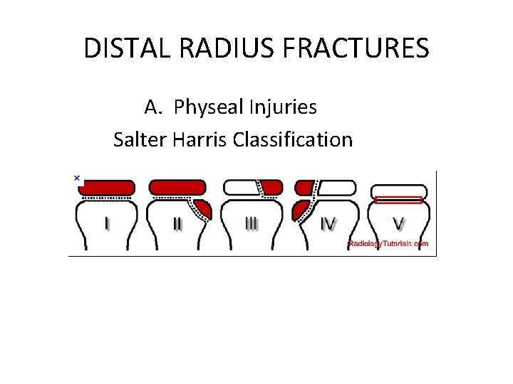 DISTAL RADIUS FRACTURES A. Physeal Injuries Salter Harris Classification DISTAL RADIUS FRACTURES A. Physeal Injuries Salter Harris Classification