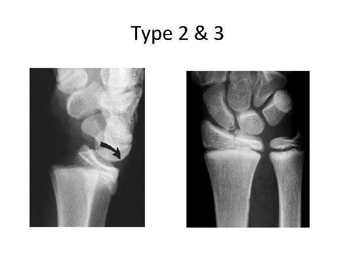 Type 2 & 3 Type 2 & 3