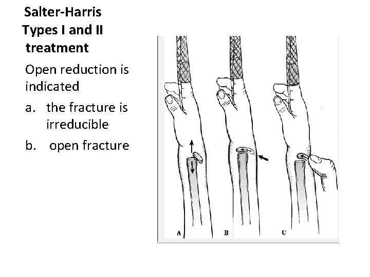 Salter-Harris Types I and II treatment Open reduction is indicated a. the fracture is Salter-Harris Types I and II treatment Open reduction is indicated a. the fracture is