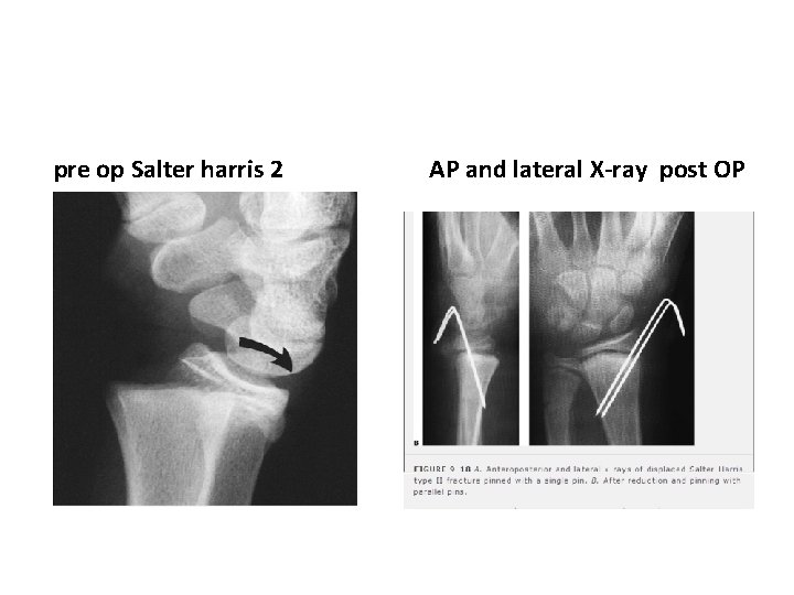 pre op Salter harris 2 AP and lateral X-ray post OP pre op Salter harris 2 AP and lateral X-ray post OP