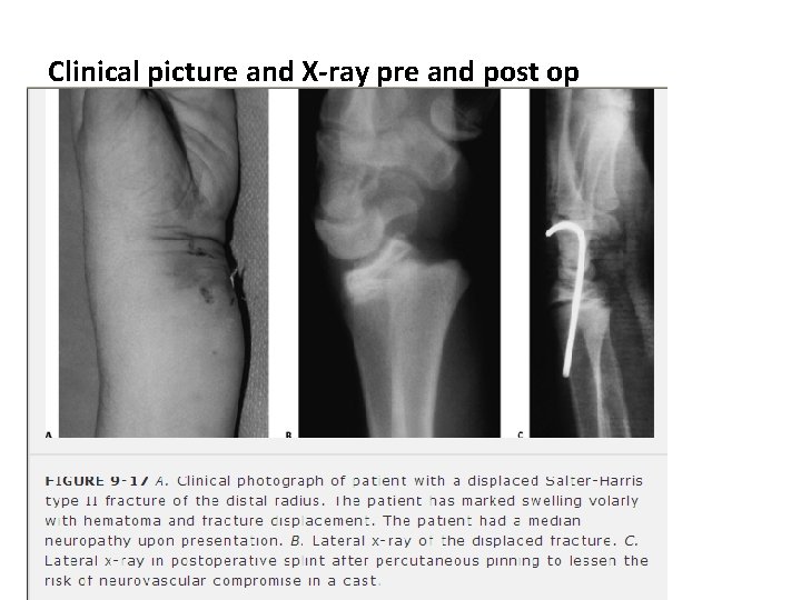Clinical picture and X-ray pre and post op Clinical picture and X-ray pre and post op