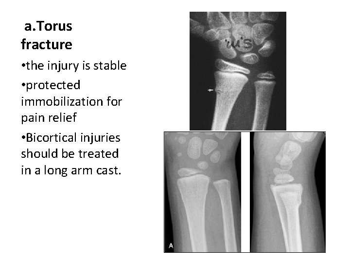 a. Torus fracture • the injury is stable • protected immobilization for pain relief a. Torus fracture • the injury is stable • protected immobilization for pain relief