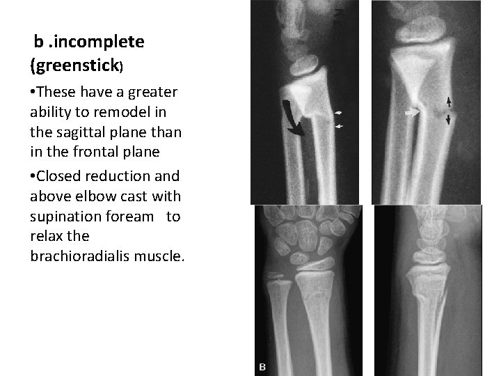 b. incomplete (greenstick) • These have a greater ability to remodel in the sagittal b. incomplete (greenstick) • These have a greater ability to remodel in the sagittal