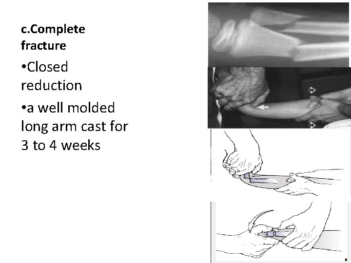c. Complete fracture • Closed reduction • a well molded long arm cast for c. Complete fracture • Closed reduction • a well molded long arm cast for