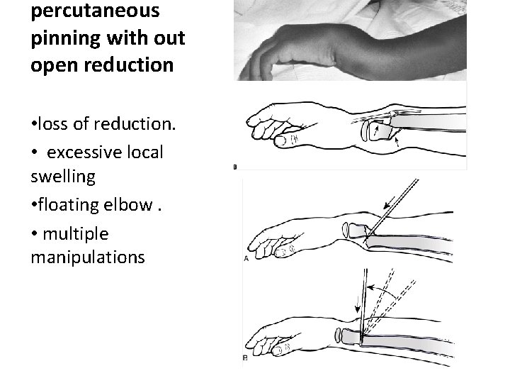 percutaneous pinning with out open reduction • loss of reduction. • excessive local swelling percutaneous pinning with out open reduction • loss of reduction. • excessive local swelling