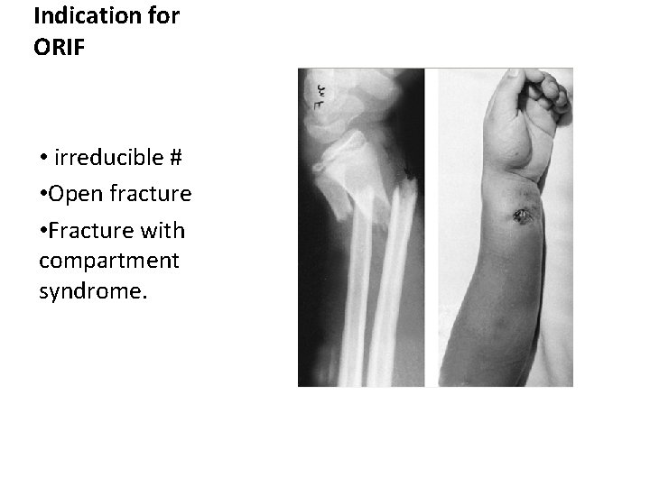 Indication for ORIF • irreducible # • Open fracture • Fracture with compartment syndrome. Indication for ORIF • irreducible # • Open fracture • Fracture with compartment syndrome.