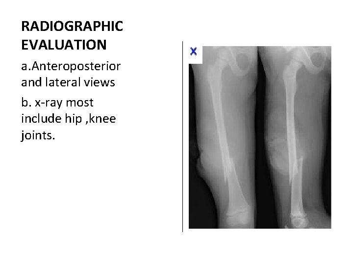 RADIOGRAPHIC EVALUATION a. Anteroposterior and lateral views b. x-ray most include hip , knee RADIOGRAPHIC EVALUATION a. Anteroposterior and lateral views b. x-ray most include hip , knee