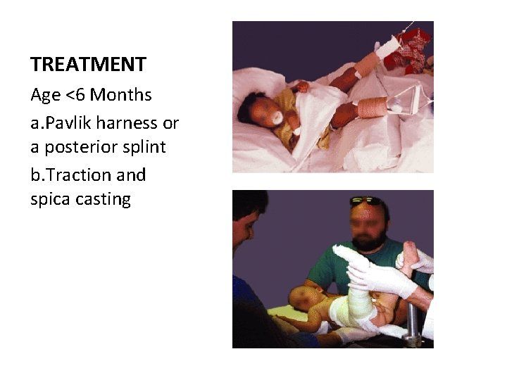 TREATMENT Age <6 Months a. Pavlik harness or a posterior splint b. Traction and TREATMENT Age <6 Months a. Pavlik harness or a posterior splint b. Traction and