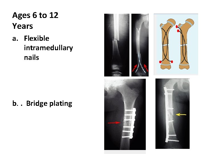Ages 6 to 12 Years a. Flexible intramedullary nails b. . Bridge plating Ages 6 to 12 Years a. Flexible intramedullary nails b. . Bridge plating