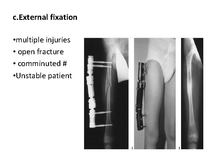 c. External fixation • multiple injuries • open fracture • comminuted # • Unstable c. External fixation • multiple injuries • open fracture • comminuted # • Unstable