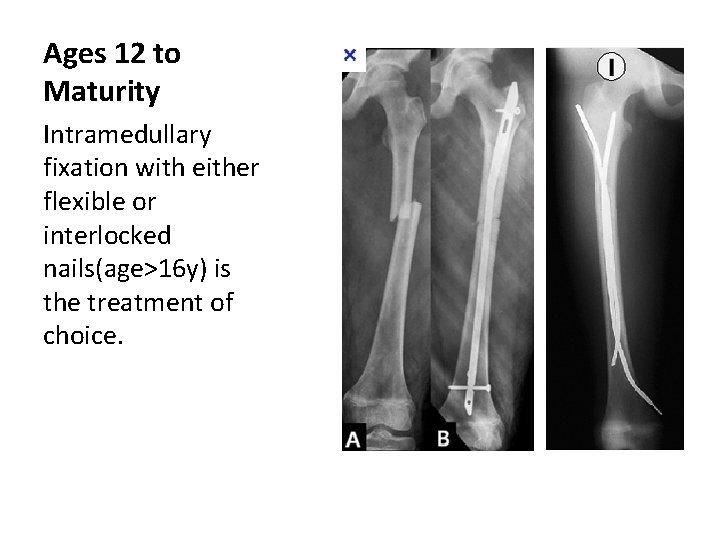 Ages 12 to Maturity Intramedullary fixation with either flexible or interlocked nails(age>16 y) is Ages 12 to Maturity Intramedullary fixation with either flexible or interlocked nails(age>16 y) is