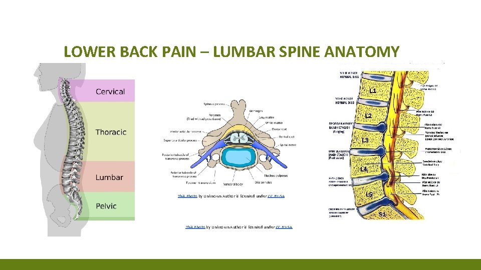 LOWER BACK PAIN – LUMBAR SPINE ANATOMY This Photo by Unknown Author is licensed LOWER BACK PAIN – LUMBAR SPINE ANATOMY This Photo by Unknown Author is licensed