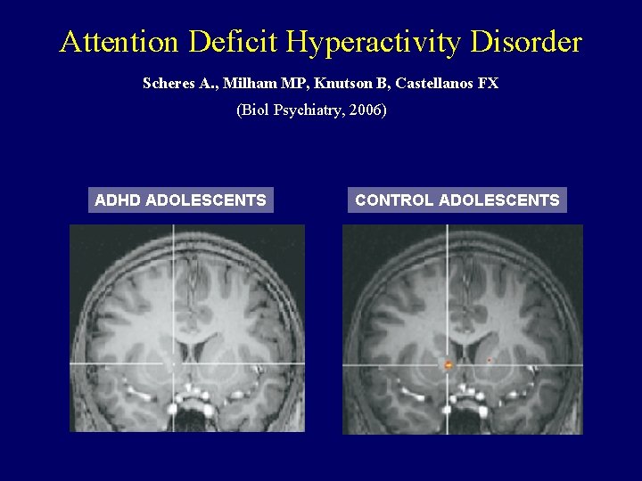 Attention Deficit Hyperactivity Disorder Scheres A. , Milham MP, Knutson B, Castellanos FX (Biol